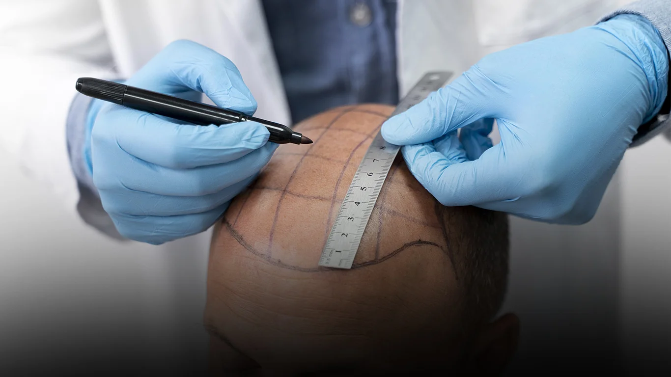 Implante Capilar con células madre, técnica FUE avanzada para recuperar cabello de manera natural